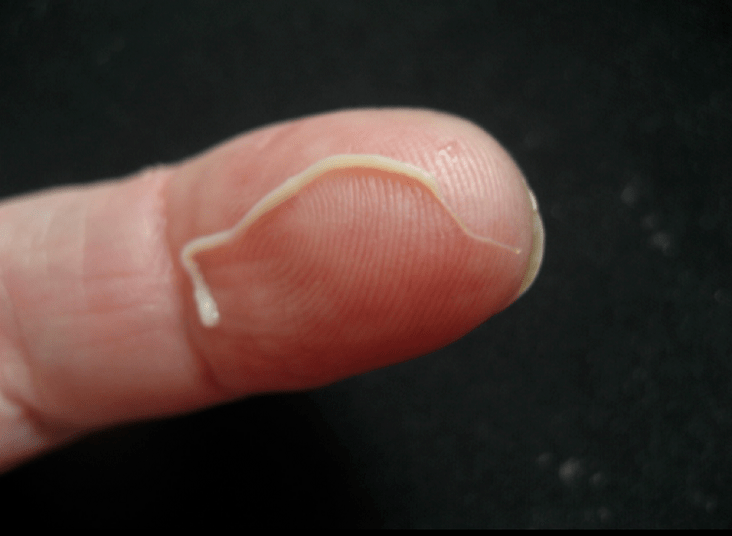 parassita nematode dal corpo umano